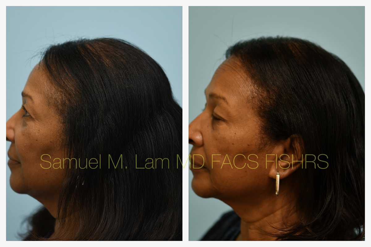 African American Hair Transplant Before and After Photo by Dr. Lam in Plano, TX