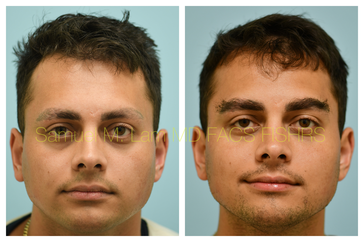 Eyebrow Hair Transplant Before and After Photo by Dr. Lam in Plano, TX