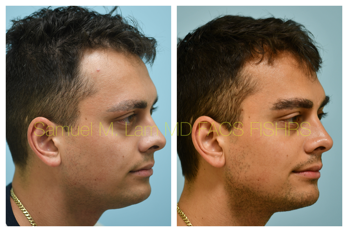 Eyebrow Hair Transplant Before and After Photo by Dr. Lam in Plano, TX