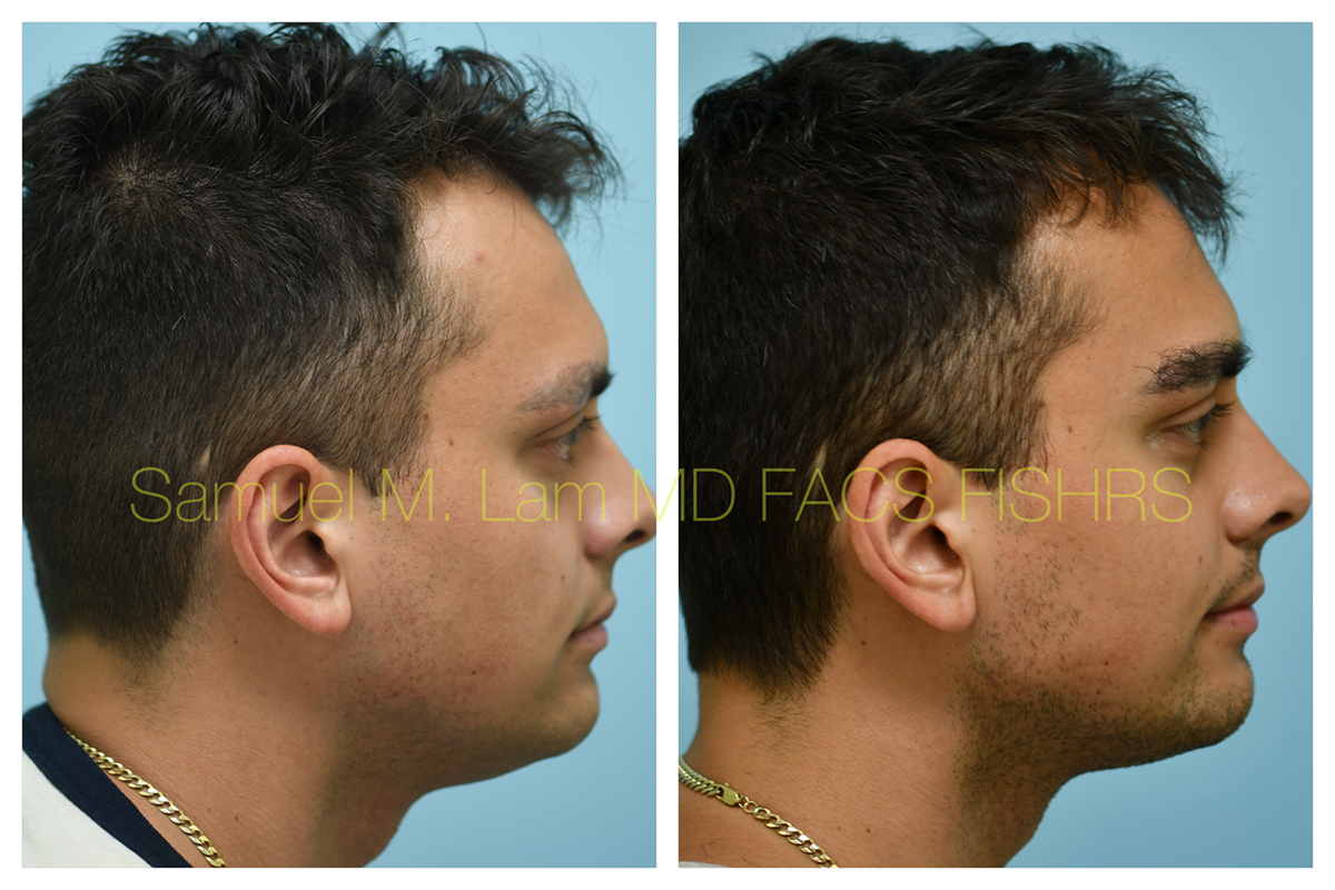 Eyebrow Hair Transplant Before and After Photo by Dr. Lam in Plano, TX