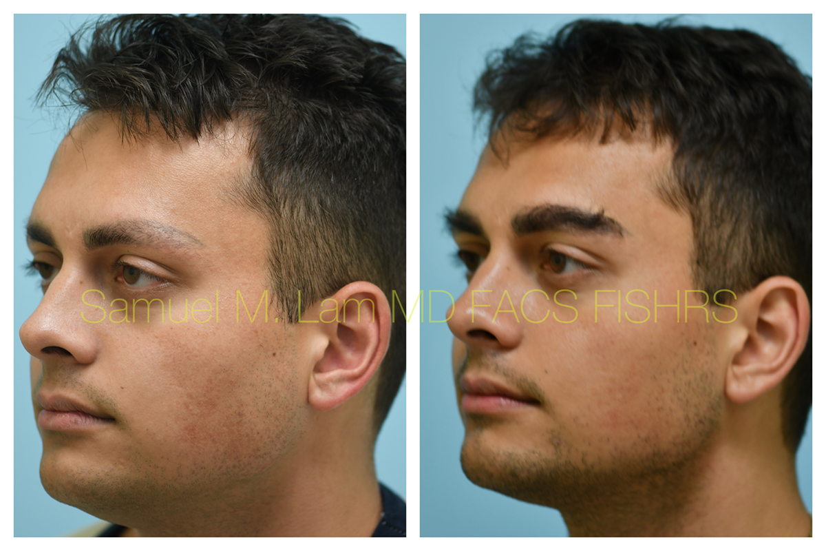 Eyebrow Hair Transplant Before and After Photo by Dr. Lam in Plano, TX