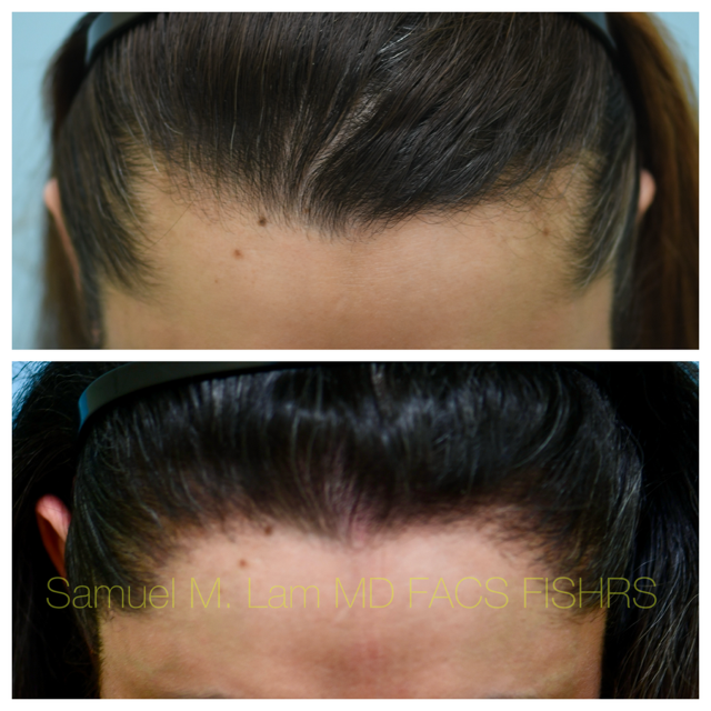 Female Hairline Lowering Before and After Photo by Dr. Lam in Plano, TX