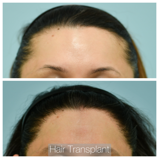 Female Hairline Lowering Before and After Photo by Dr. Lam in Plano, TX