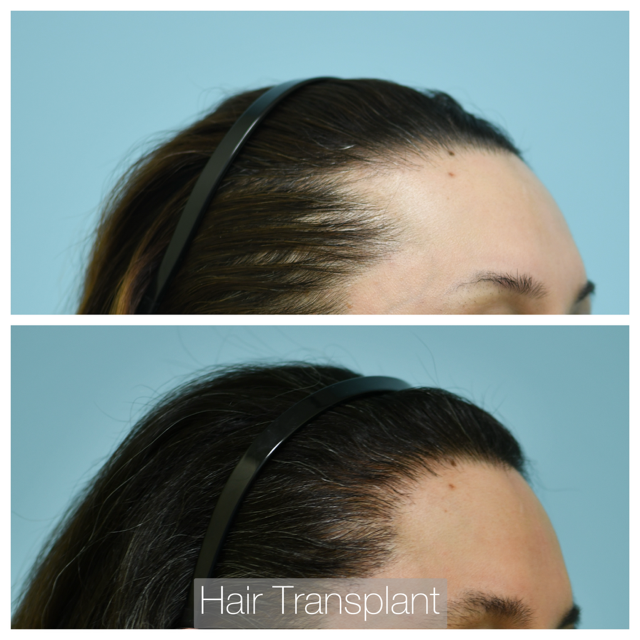 Female Hairline Lowering Before and After Photo by Dr. Lam in Plano, TX