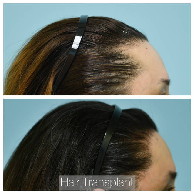 Female Hairline Lowering Before and After Photo by Dr. Lam in Plano, TX