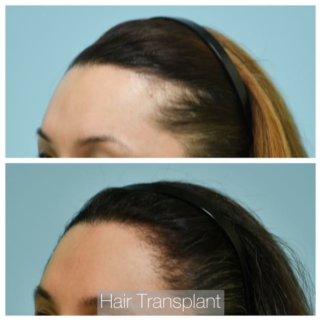 Female Hairline Lowering Before and After Photo by Dr. Lam in Plano, TX