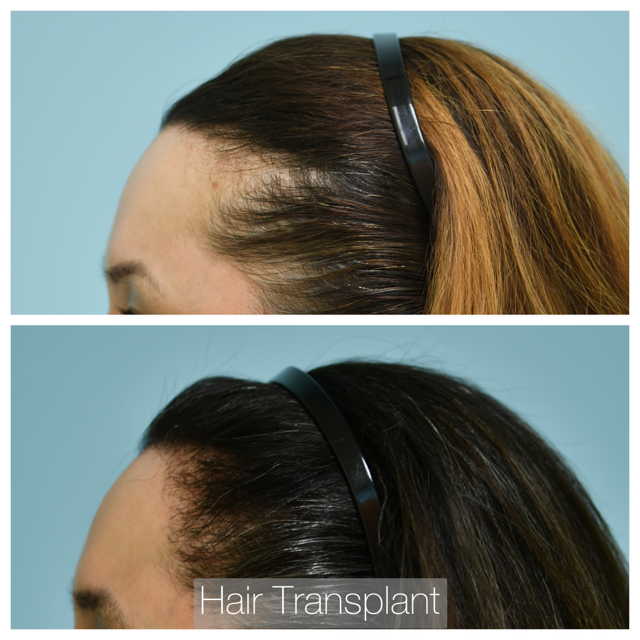 Female Hairline Lowering Before and After Photo by Dr. Lam in Plano, TX