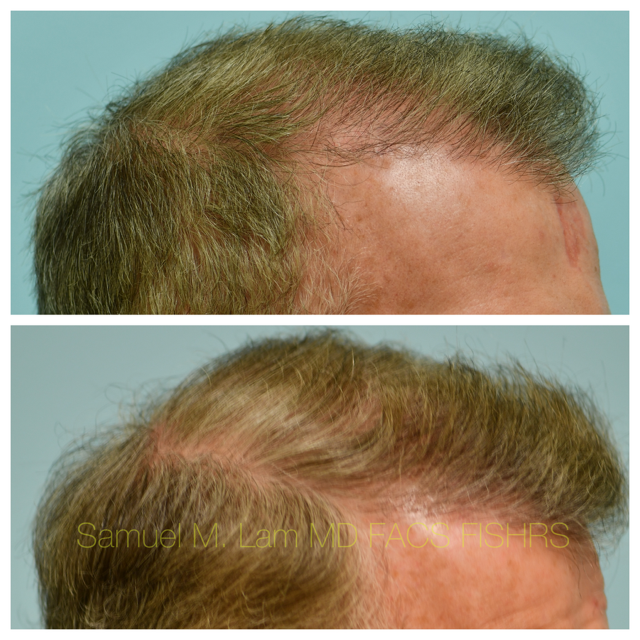Hairline and Central Density Before and After Photo by Dr. Lam in Plano, TX