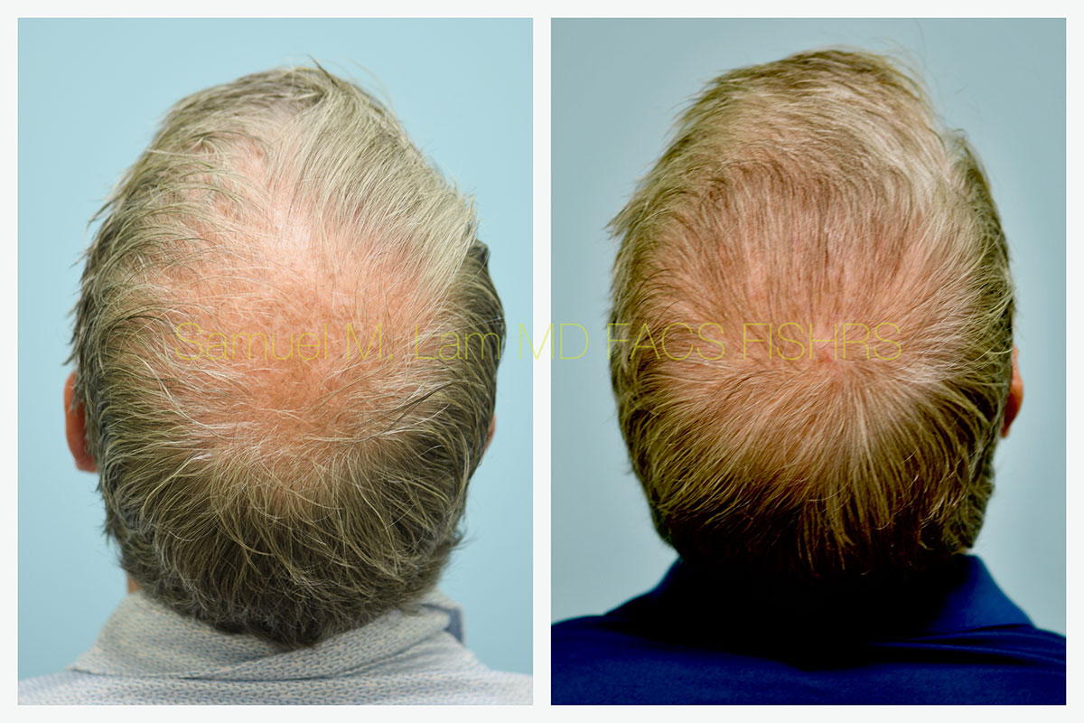 Crown Hair Transplant Before and After Photo by Dr. Lam in Plano, TX