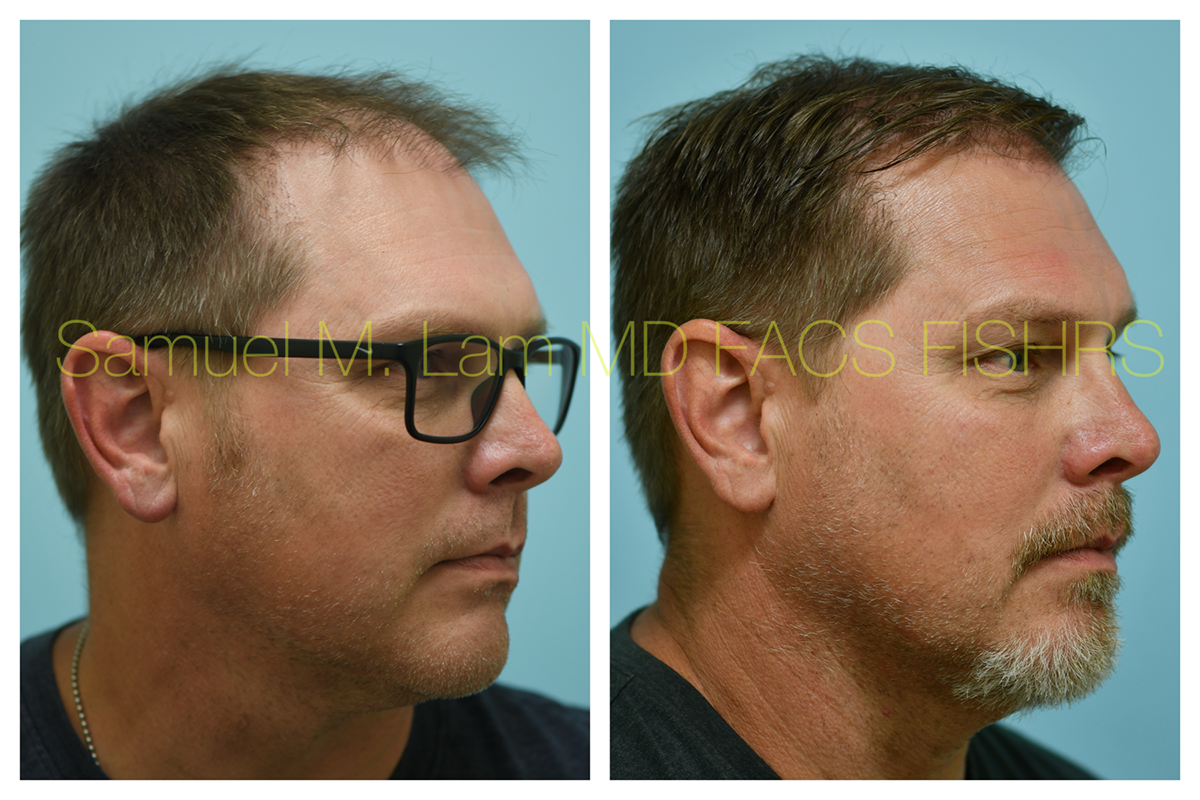 Hair Transplant Before and After Photo by Dr. Lam in Plano, TX