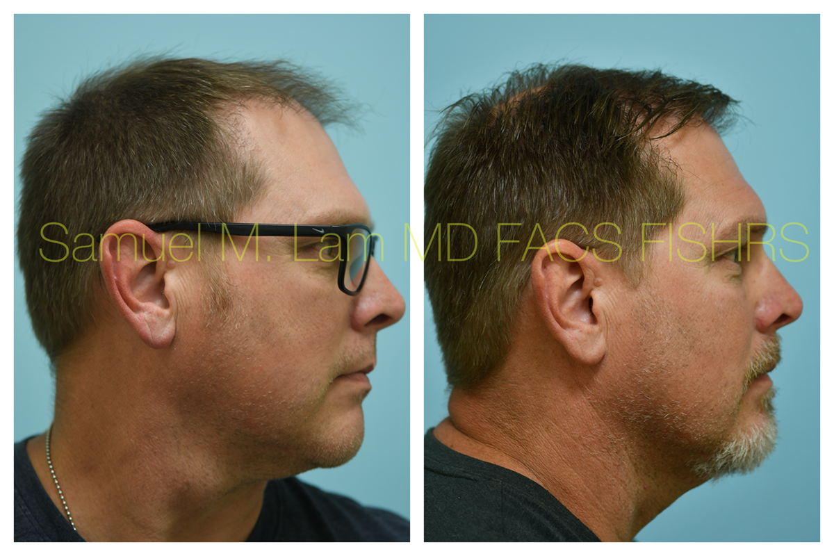 Hair Transplant Before and After Photo by Dr. Lam in Plano, TX