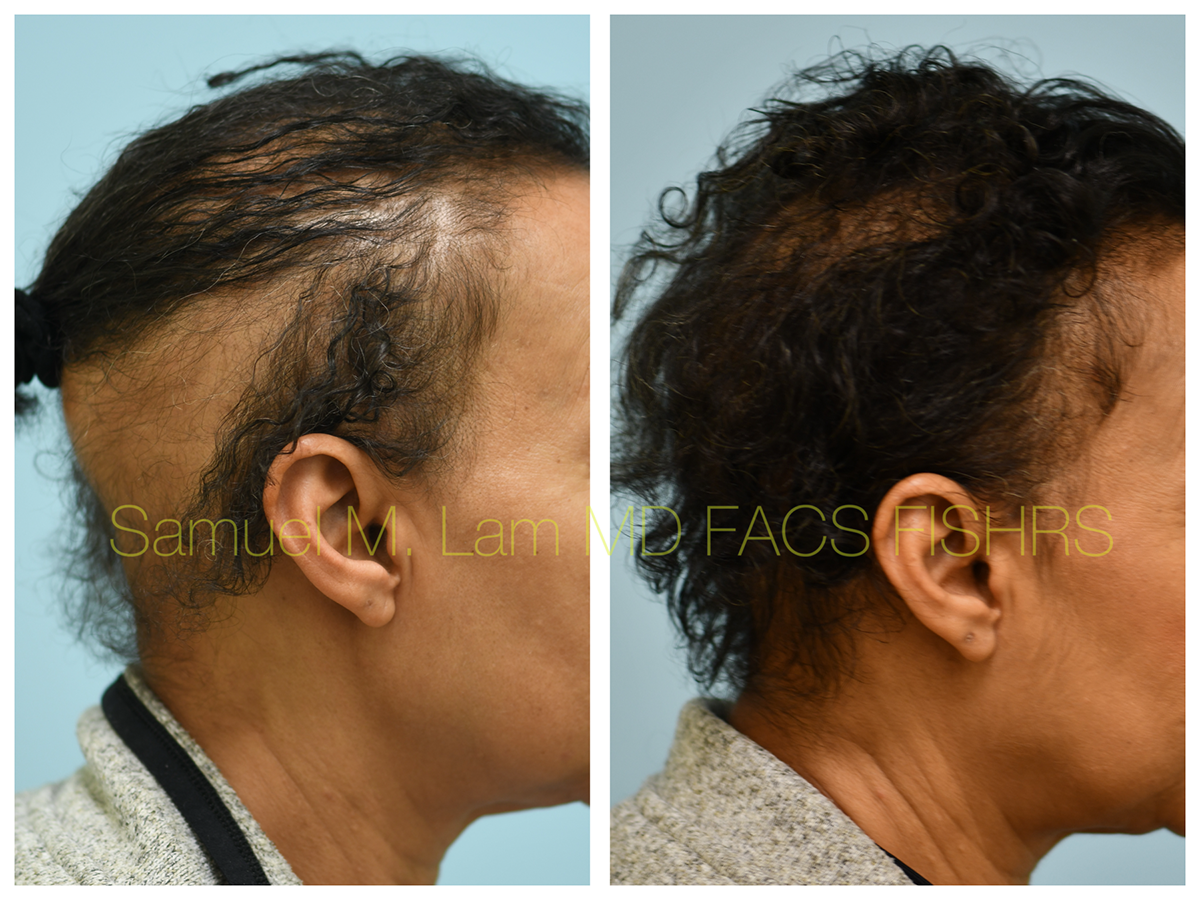 Hair Stem Before and After Photo by Dr. Lam in Plano, TX
