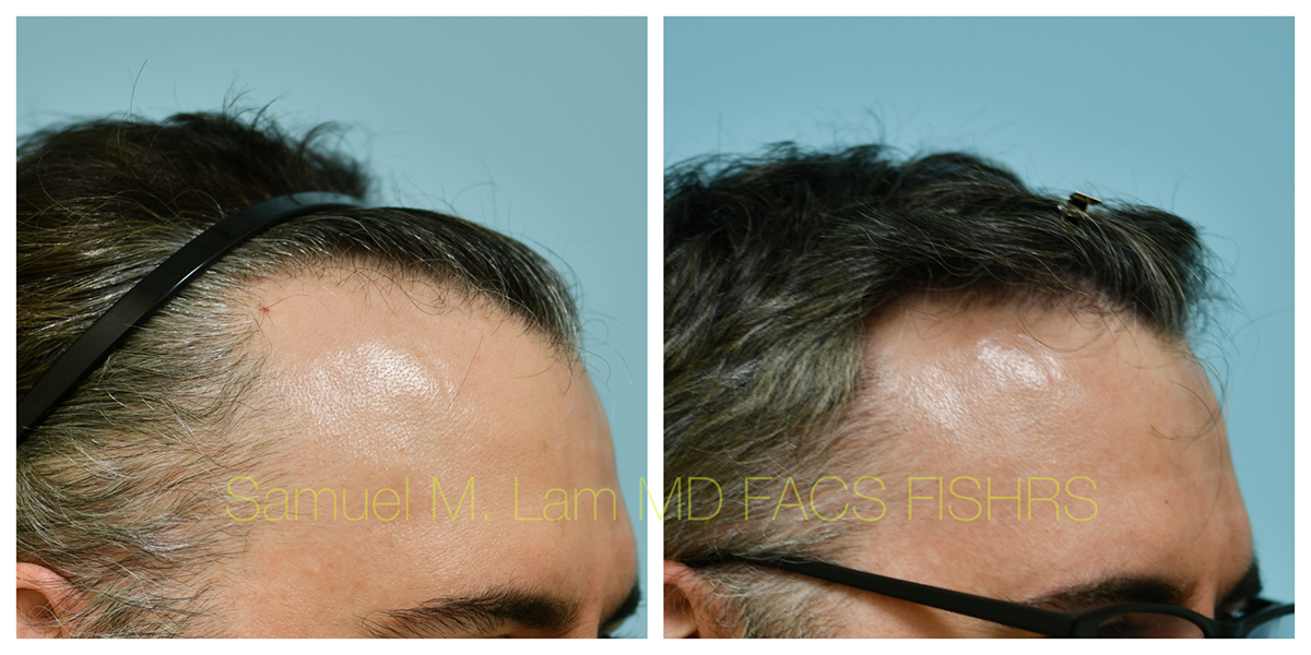 Hair Transplant Before and After Photo by Dr. Lam in Plano, TX