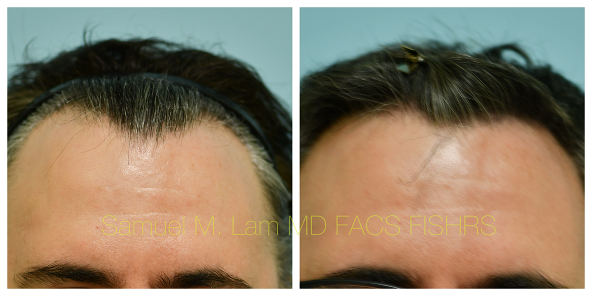 Hair Transplant Before and After Photo by Dr. Lam in Plano, TX