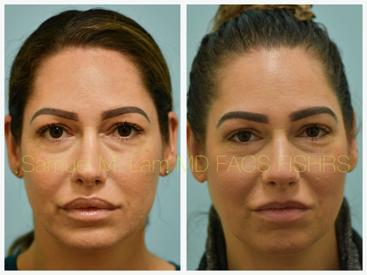 Eyebrow Transplant Before and After Photo by Dr. Lam in Plano, TX