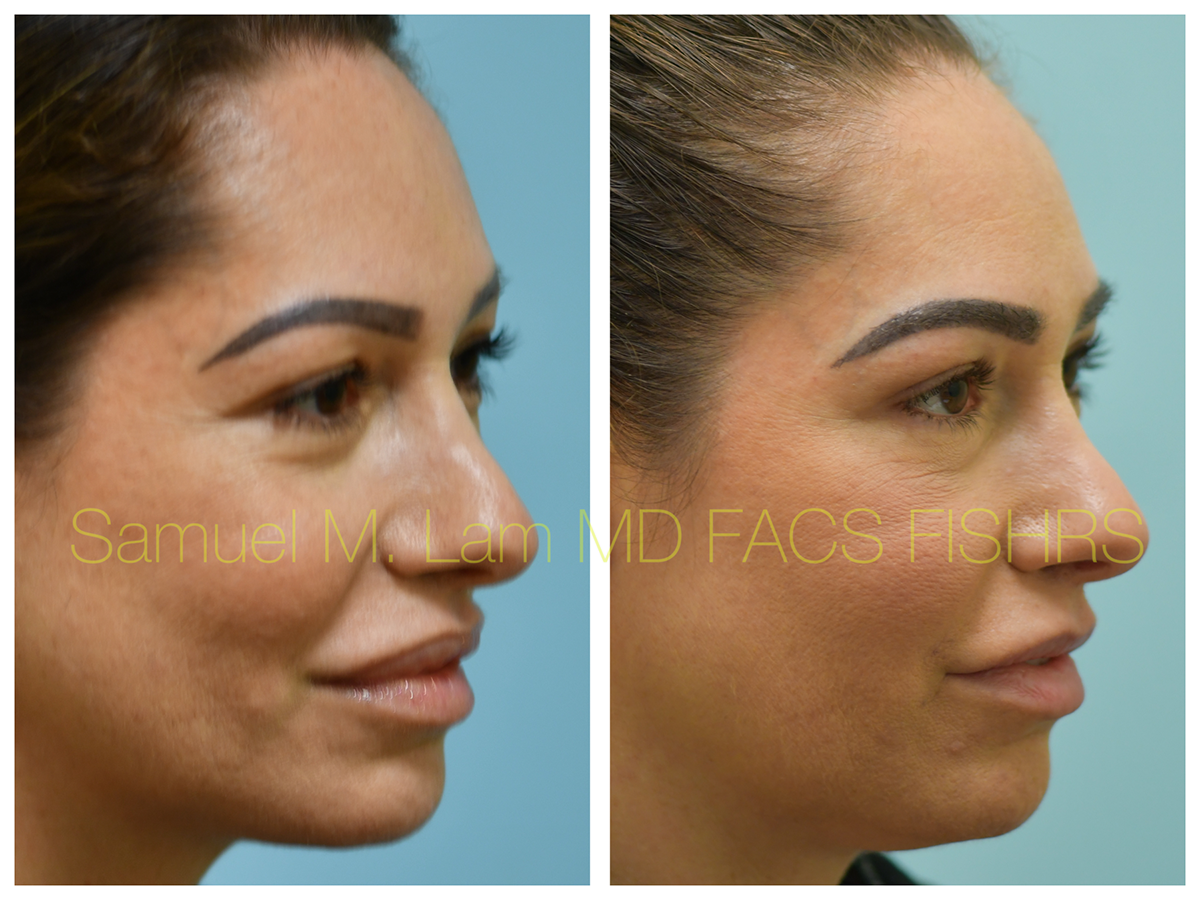 Eyebrow Transplant Before and After Photo by Dr. Lam in Plano, TX