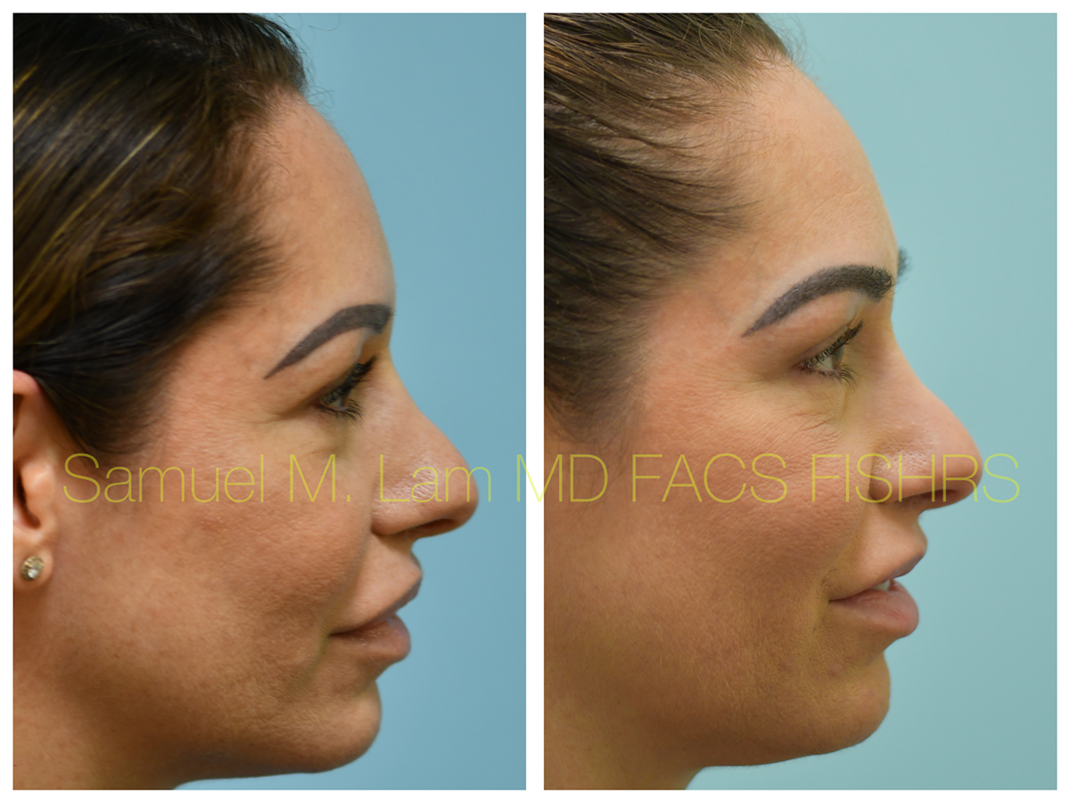 Eyebrow Transplant Before and After Photo by Dr. Lam in Plano, TX
