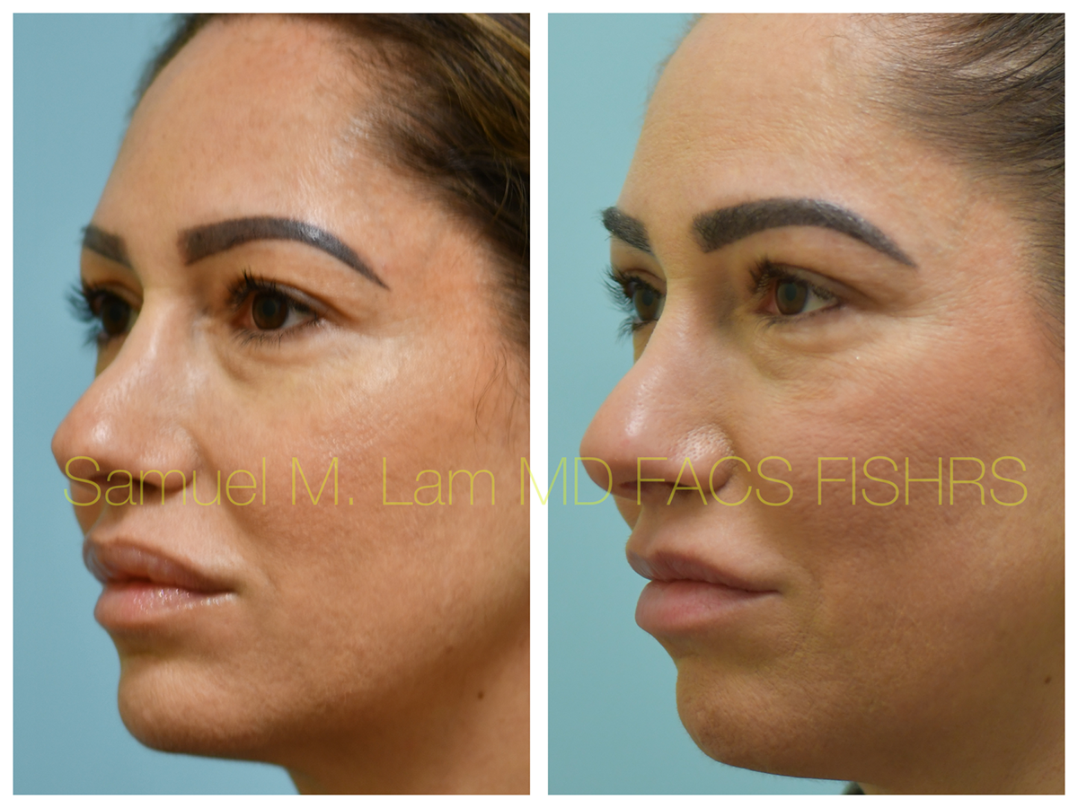 Eyebrow Transplant Before and After Photo by Dr. Lam in Plano, TX