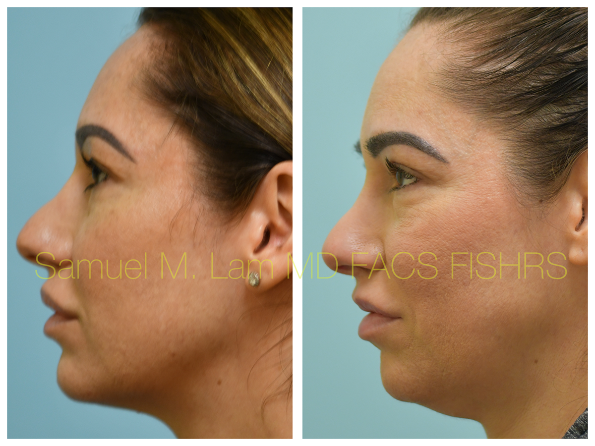 Eyebrow Transplant Before and After Photo by Dr. Lam in Plano, TX