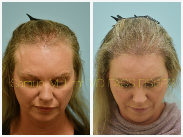 Hair Transplant Before and After Photo by Dr. Lam in Plano, TX
