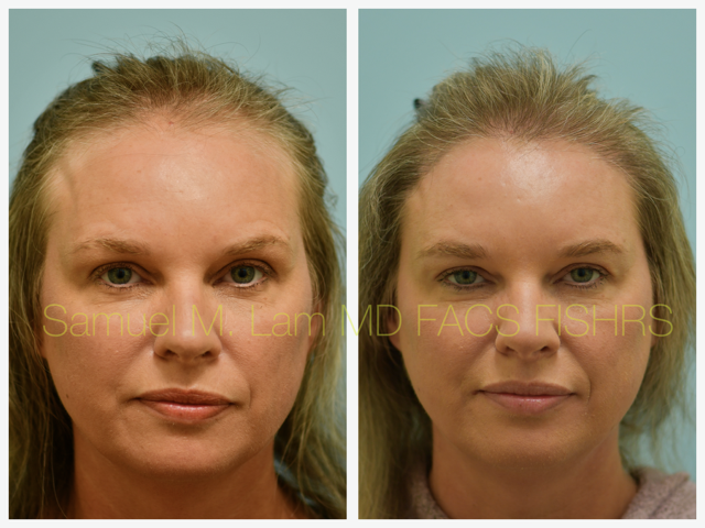 Hair Transplant Before and After Photo by Dr. Lam in Plano, TX