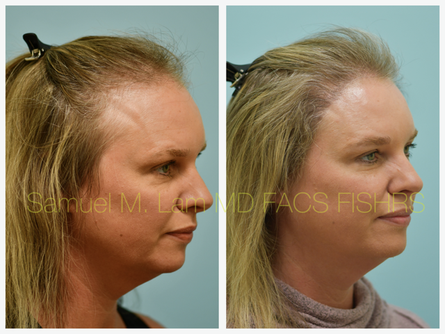 Hair Transplant Before and After Photo by Dr. Lam in Plano, TX