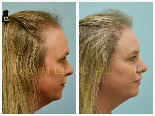 Hair Transplant Before and After Photo by Dr. Lam in Plano, TX