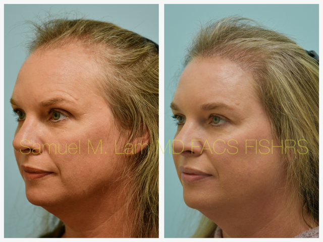 Hair Transplant Before and After Photo by Dr. Lam in Plano, TX