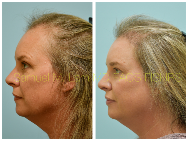 Hair Transplant Before and After Photo by Dr. Lam in Plano, TX