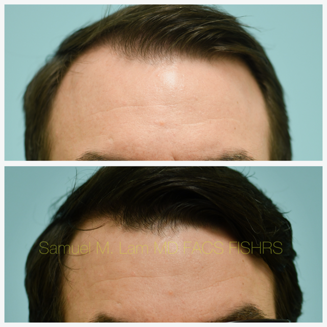 Hairline and Central Density Before and After Photo by Dr. Lam in Plano, TX