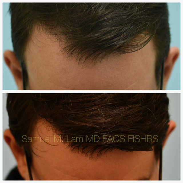 Hairline and Central Density Before and After Photo by Dr. Lam in Plano, TX