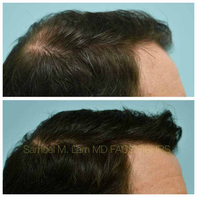 Hairline and Central Density Before and After Photo by Dr. Lam in Plano, TX