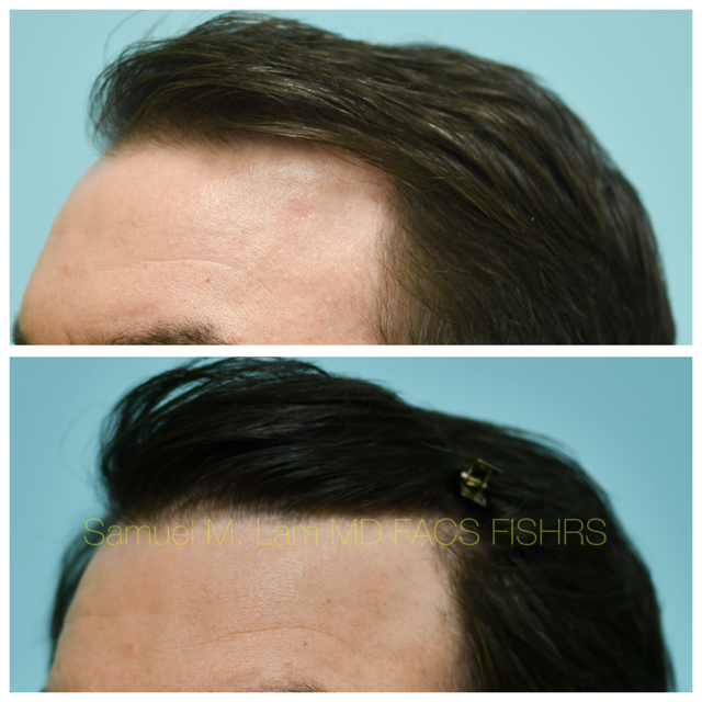 Hairline and Central Density Before and After Photo by Dr. Lam in Plano, TX