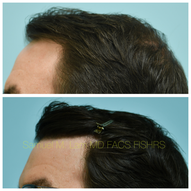 Hairline and Central Density Before and After Photo by Dr. Lam in Plano, TX