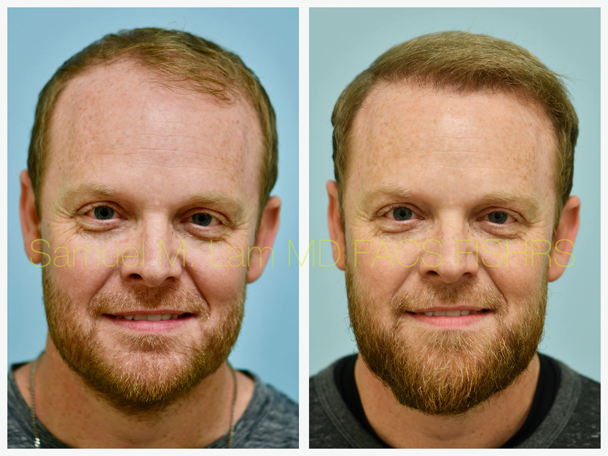Central Hair Density Before and After Photo by Dr. Lam in Plano, TX