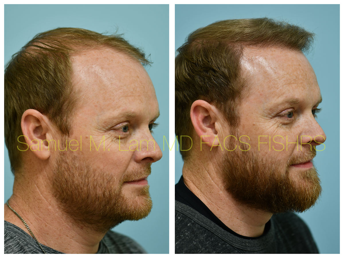 Central Hair Density Before and After Photo by Dr. Lam in Plano, TX