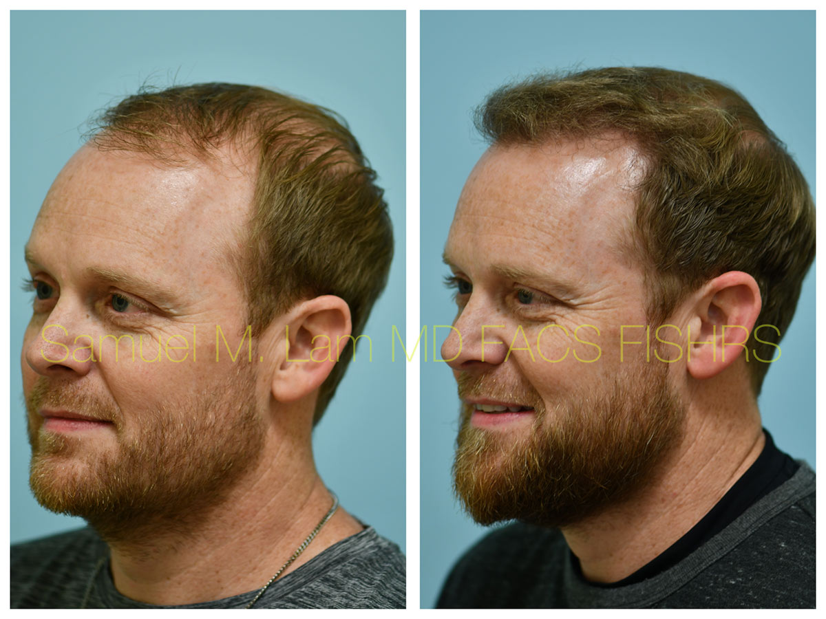 Central Hair Density Before and After Photo by Dr. Lam in Plano, TX