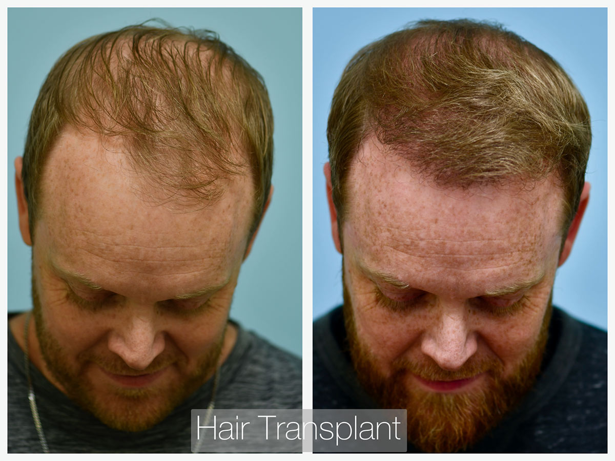 Central Hair Density Before and After Photo by Dr. Lam in Plano, TX