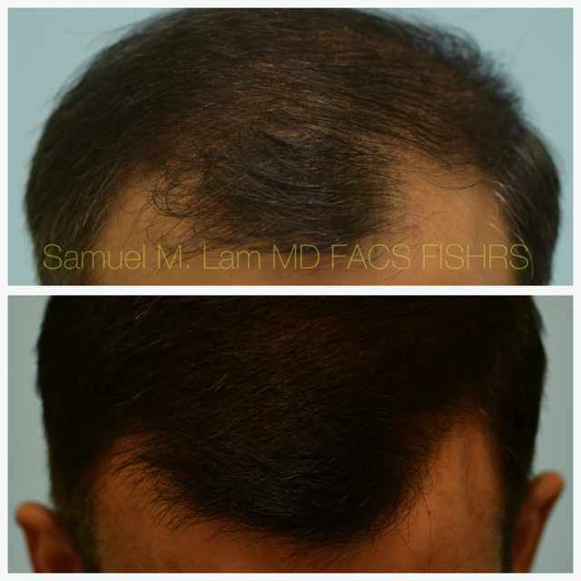 Crown (or vertex) Hair Restoration Before and After Photo by Dr. Lam in Plano, TX