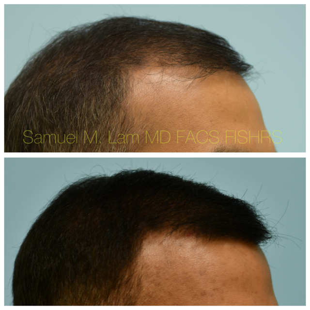 Crown (or vertex) Hair Restoration Before and After Photo by Dr. Lam in Plano, TX