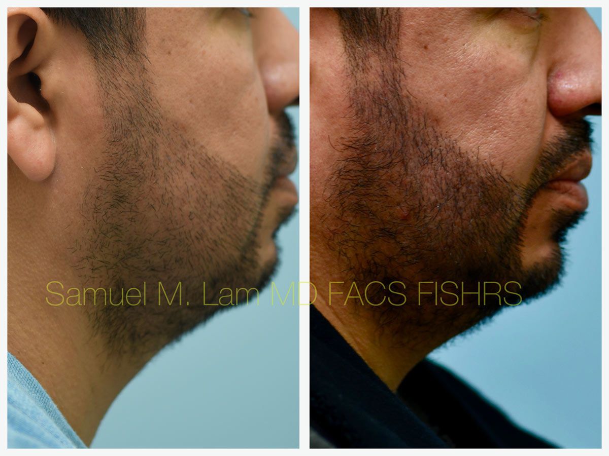 FUE hair transplant Before and After Photo by Dr. Lam in Plano, TX