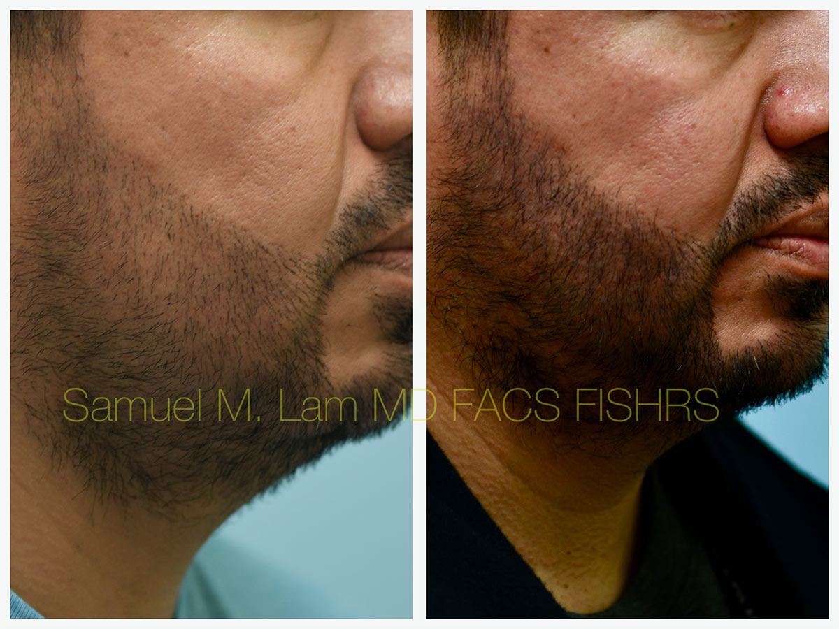 FUE hair transplant Before and After Photo by Dr. Lam in Plano, TX