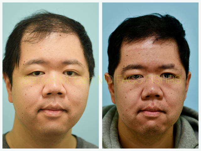 Hair Stem Therapy Before and After Photo by Dr. Lam in Plano, TX
