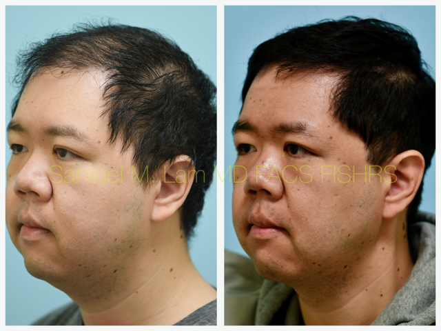 Hair Stem Therapy Before and After Photo by Dr. Lam in Plano, TX