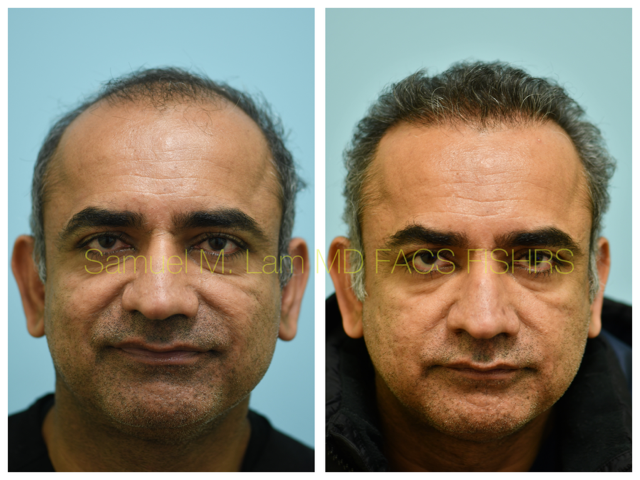 Hair Transplant Before and After Photo by Dr. Lam in Plano, TX
