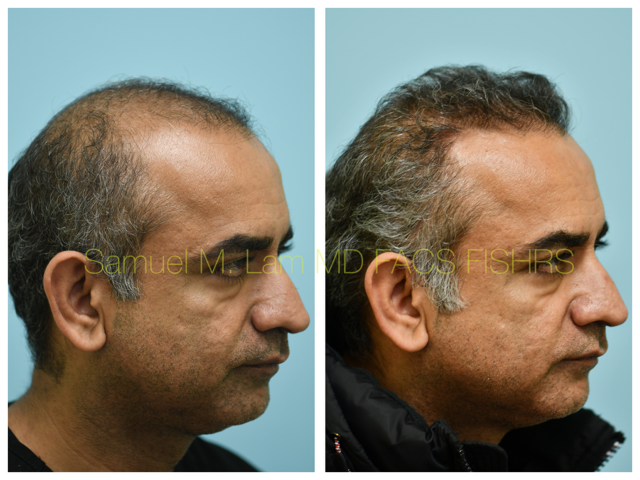 Hair Transplant Before and After Photo by Dr. Lam in Plano, TX