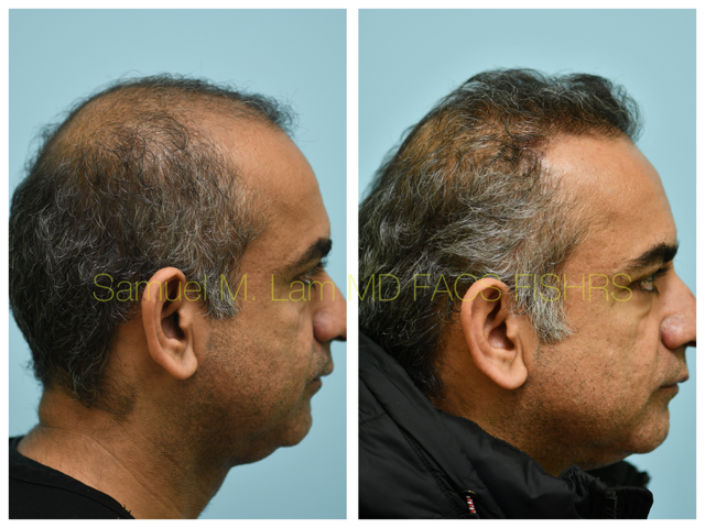 Hair Transplant Before and After Photo by Dr. Lam in Plano, TX
