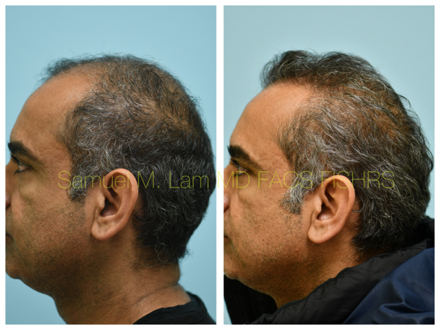 Hair Transplant Before and After Photo by Dr. Lam in Plano, TX