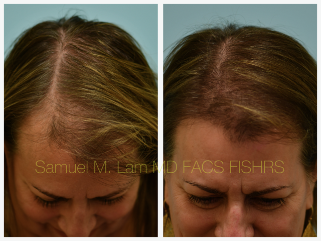 Hairline Lowering Before and After Photo by Dr. Lam in Plano, TX