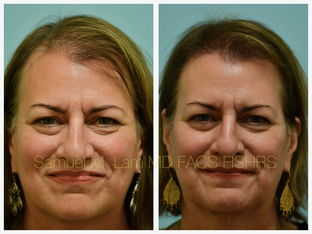 Hairline Lowering Before and After Photo by Dr. Lam in Plano, TX